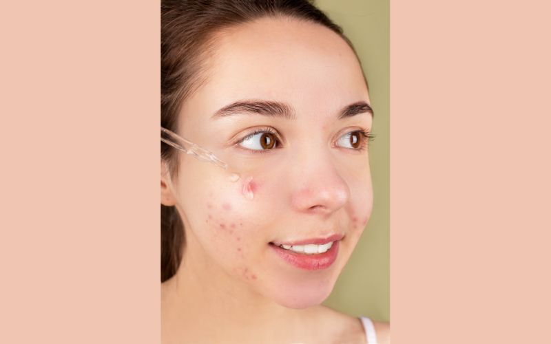 Spot Treatment: Use targeted treatments for active breakouts.